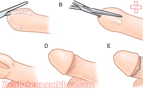 CÁCH CHỮA HẸP BAO QUY ĐẦU HIỆU QUẢ