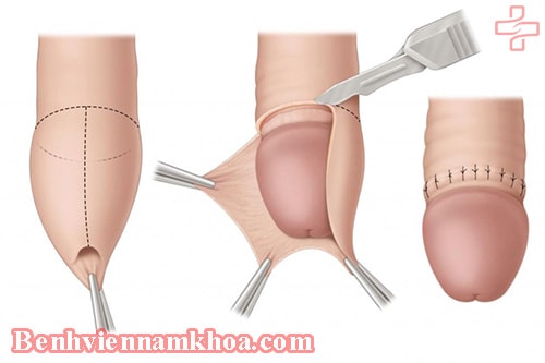 Cách điều trị hẹp bao quy đầu ở người lớn