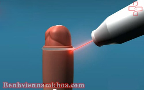 Cắt bao quy đầu bằng laser có ưu và nhược điểm gì