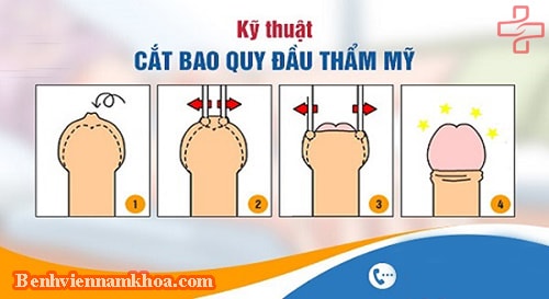 Cắt bao quy đầu thẩm mỹ là gì