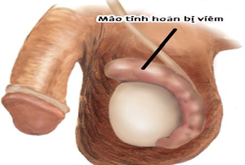 dấu hiệu cảnh báo về bệnh viêm mào tinh hoàn