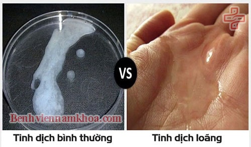 Tinh trùng loãng có phải yếu không?