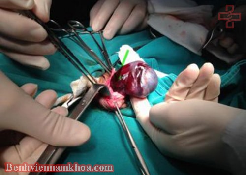 Phẫu thuật giãn tĩnh mạch thừng tinh