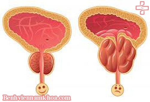 Phì đại tiền liệt tuyến theo y học cổ truyền