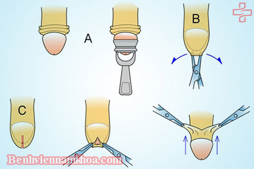 Phương pháp phẫu thuật hẹp bao quy đầu
