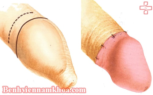 Quy trình cắt bao quy đầu