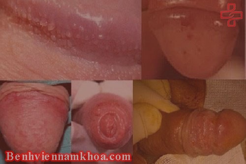 Viêm loét bao quy đầu