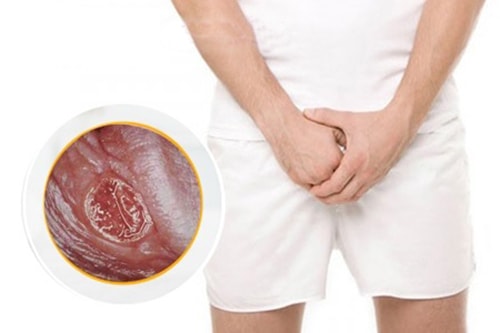Bệnh giang mai có chữa được không
