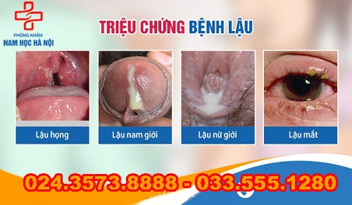 Bệnh lậu biểu hiện như thế nào?