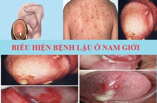 Bệnh lậu biểu hiện ở nam giới