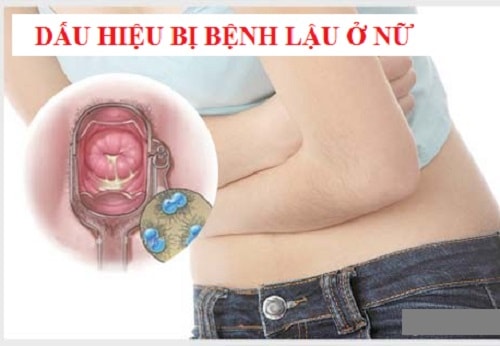 Bệnh lậu biểu hiện ở nữ giới