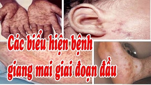Biểu hiện bệnh giang mai giai đoạn một
