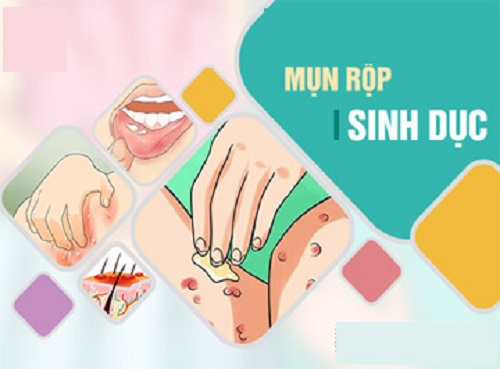 Tổng quan về mụn rộp sinh dục