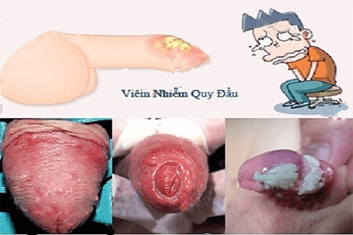 Các triệu chứng ngứa bao quy đầu