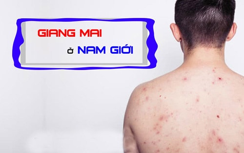 Điều trị giang mai ở nam giới
