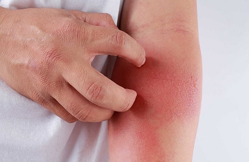 Đỏ bao quy đầu do viêm da tiếp xúc