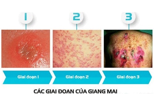 Giang mai giai đoạn 1