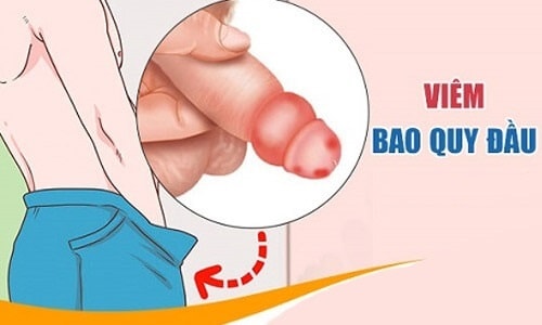 Nguyên nhân khiến bao quy đầu bị sưng 1