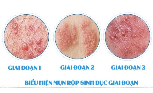 Nguyên nhân khiến bao quy đầu bị sưng 2