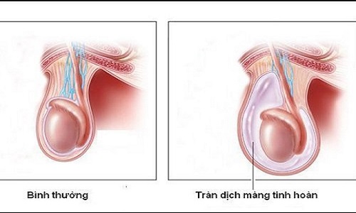 Tràn dịch màng tinh hoàn