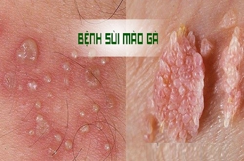 Triệu chứng sùi mào gà