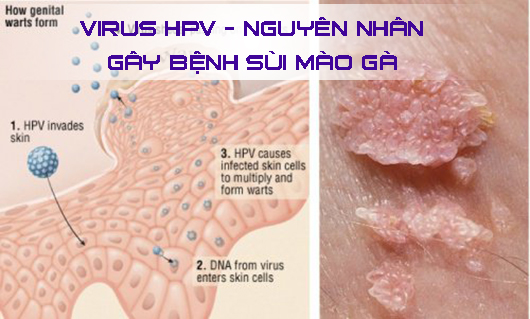 cậu nhỏ ngứa nổi mụn là bị sùi mào gà