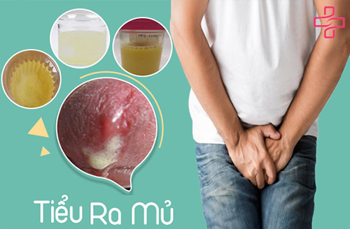 tiểu ra mủ