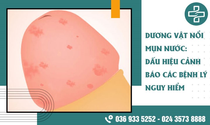 Dương vật nổi mụn nước: Dấu hiệu cảnh báo các bệnh lý nguy hiểm