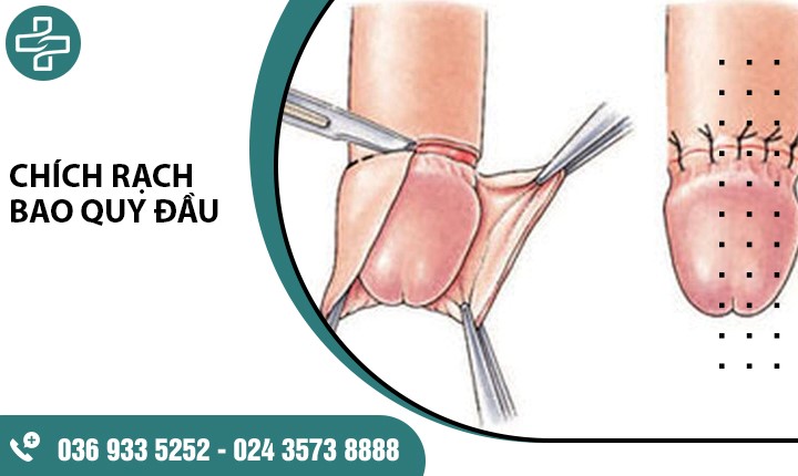 Chích rạch bao quy đầu là gì? 1 số lưu ý khi chích rạch