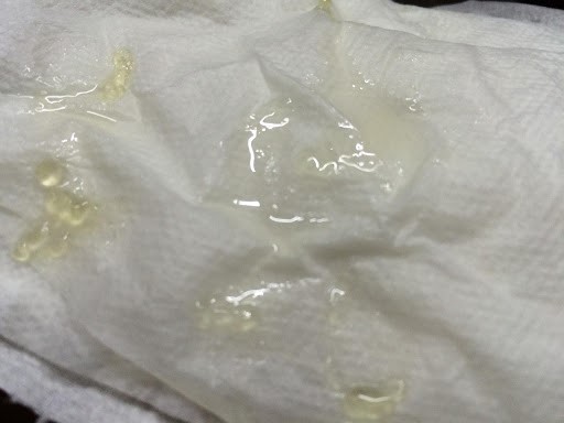 DẤU HIỆU NHẬN BIẾT TINH DỊCH VÓN CỤC LÀ GÌ?