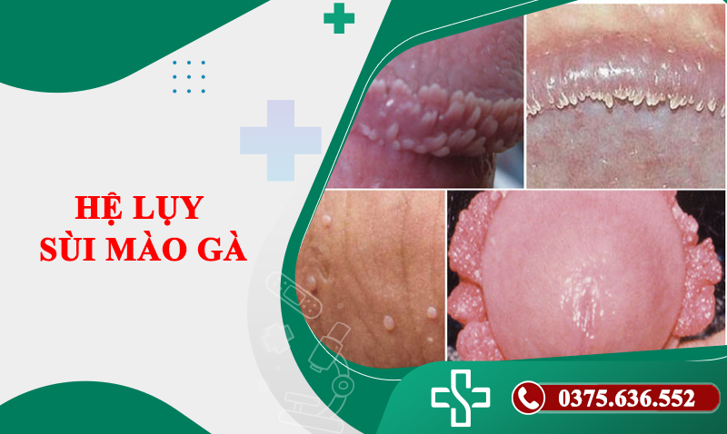 Hệ lụy sùi mào gà