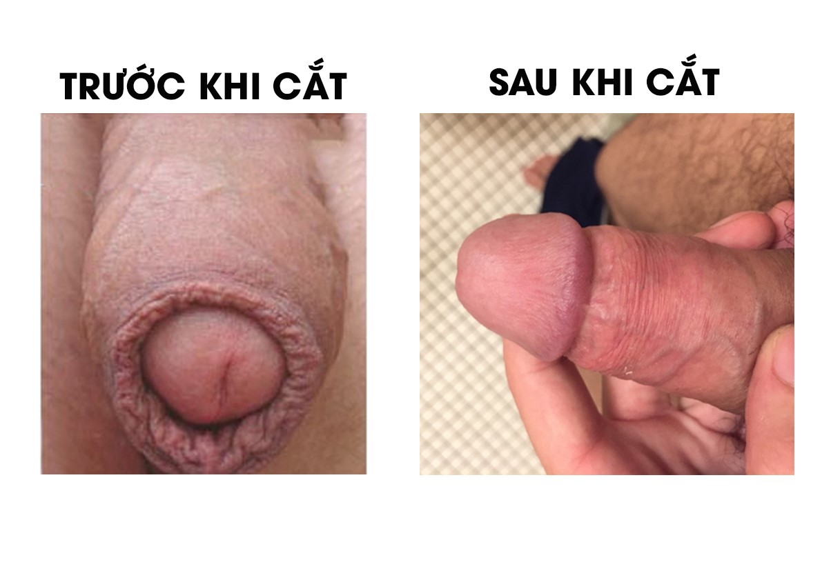 kết quả sau khi cắt bao quy đầu thẩm mỹ kết quả sau khi cắt bao quy đầu thẩm mỹ