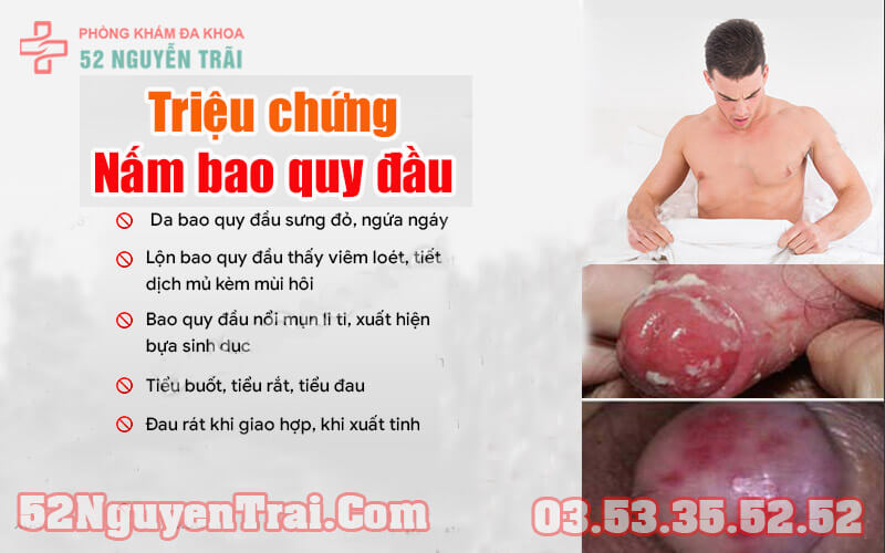 Nấm bao quy đầu: Căn bệnh nguy hiểm những ít ai để ý