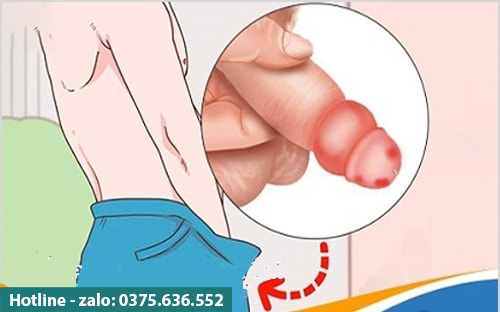 Bao quy đầu nổi mẩn đỏ nguy hiểm không ?