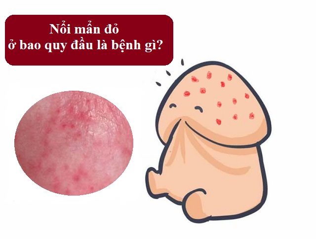 bao quy đầu nổi mẩn đỏ 