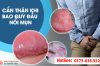 Đầu dương vật sưng đỏ, ngứa, đau rát và có dịch mủ là bị gì