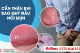Đầu dương vật sưng đỏ, ngứa, đau rát và có dịch mủ là bị gì