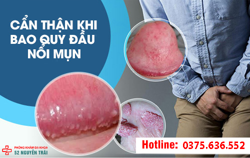 Cẩn thật khi bao quy đầu nổi mụn thịt