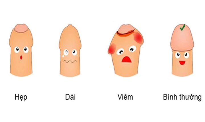 cắt bao quy đàu khi bị dài hoặc hẹp
