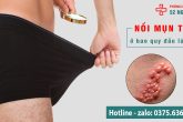 BAO QUY ĐẦU NỔI MỤN THỊT LÀ BỊ BỆNH GÌ?