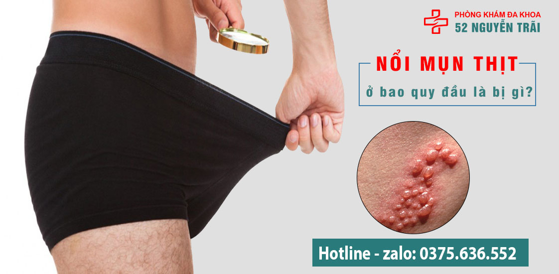 Nổi mụn ở bao quy đầu bao quy đầu nổi mụn thịt