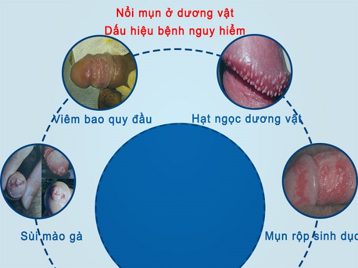 Bao quy đầu nổi mẩn đỏ là bệnh gì ?