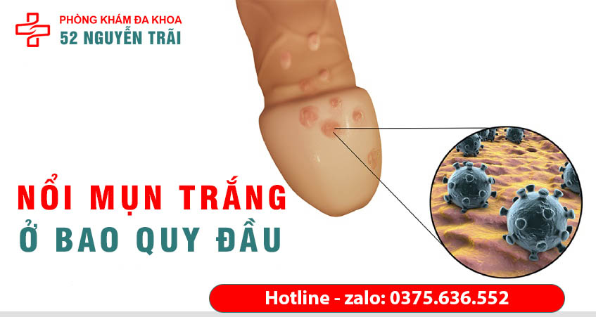nổi mụn trắng ở bao quy đầu