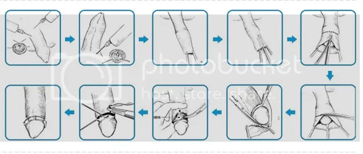 Nghe chuyên gia giải đáp: Tại sao phải cắt bao quy đầu?