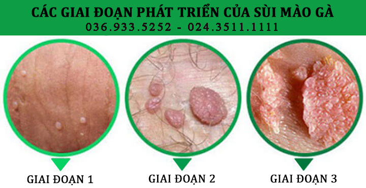 Nhận biết sớm các biểu hiệu sùi mào gà ở cả nam và nữ giới