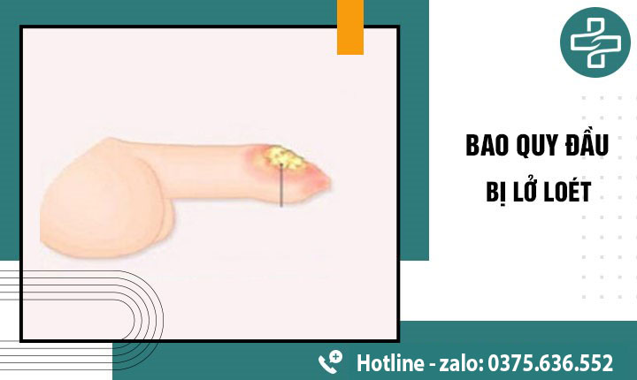 chữa viêm loét bao quy đầu