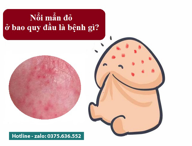 nổi mẩn đỏ ở bao quy đầu ?