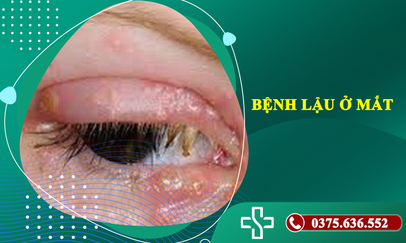 bệnh lậu ở mắt