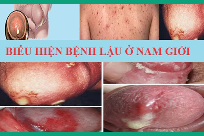 bệnh lậu ở nam giới