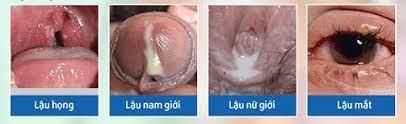 bệnh lậu
